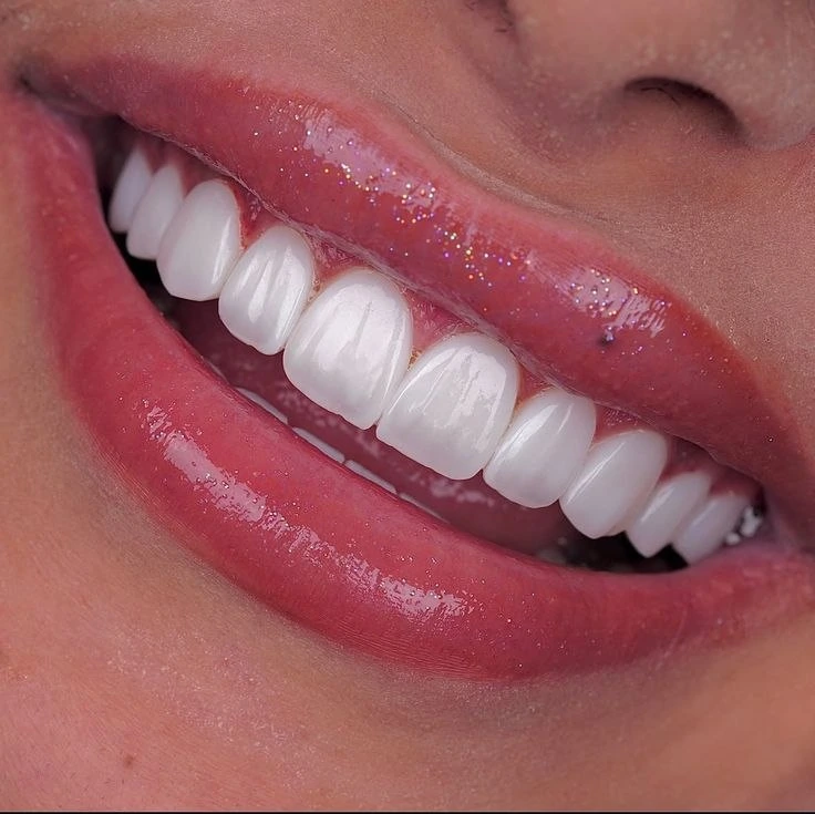 The art of a signature smile with porcelain veneers